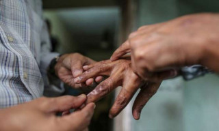 बाँकेमा १ सय ४६ जना नयाँ कुष्ठरोगका बिरामी फेला